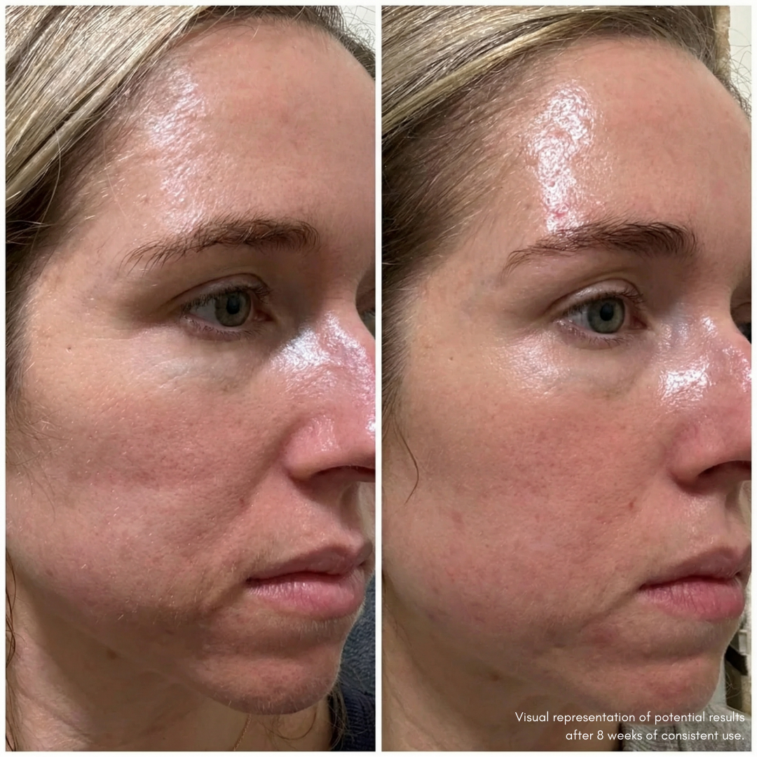 InfraTheory™ LED Light Therapy Mask